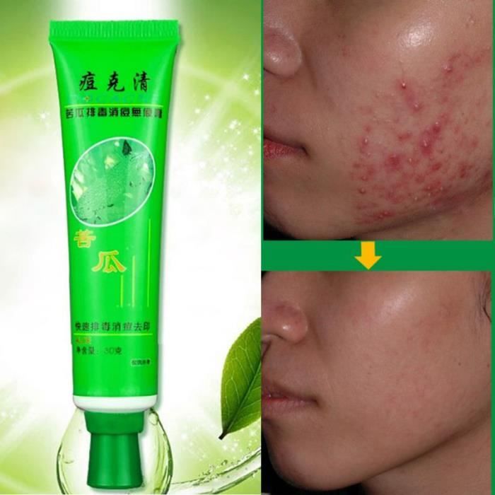 Le masque pour la personne de lalbumine contre les boutons