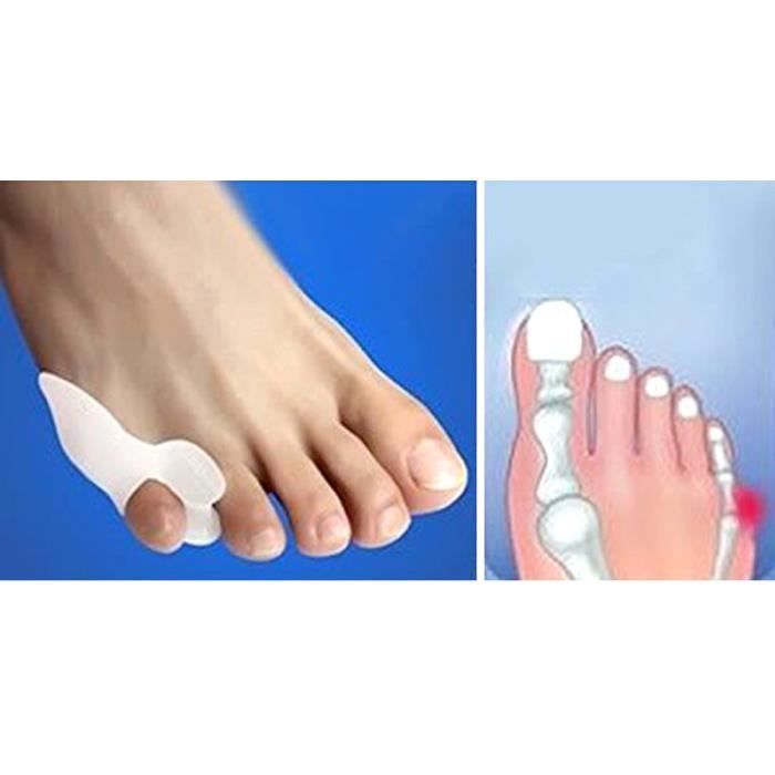 hallux valgus orteil hallux valgus orteil